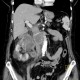 Polycystic kidney, adult polycystic kidney disease, ADPKD, renal carcinoma, liver metastasis, nodal involvement: CT - Computed tomography